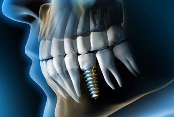 dental-implant-product